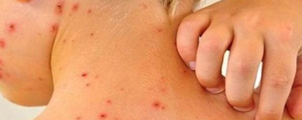 Менингококктын өвчлөл V сар хүртэл өндөр эрсдэлтэй!